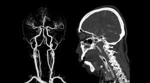 CT Angiografi Diperluas vs CT Angiografi Standar dalam Penatalaksanaan Stroke Iskemik – Telaah Jurnal Alomedika