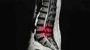 Peran Endoscopic Lumbar Discectomy pada Hernia Nukleus Pulposus Lumbar