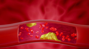 Regresi Plak Aterosklerosis: Mungkinkah?