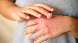 Perbandingan Agen Topikal untuk Penatalaksanaan Dermatitis Atopik