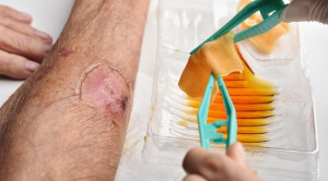 Peran Antiseptik Topikal dalam Penanganan Infeksi pada Luka Kronis