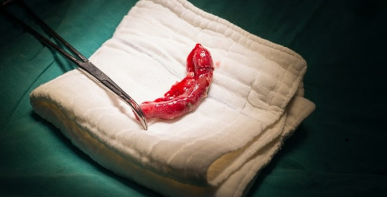 Apendektomi Laparoskopik VS Apendektomi Terbuka pada Appendicitis Akut