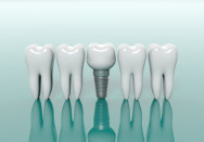 Minimalinvasiven Techniken sind besonders schonend und sorgen für festsitzenden und dauerhaften Zahnersatz. - (c) viperagp Fotolia 
