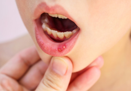Nahaufnahme eines Mundes mit einem offenen Kinn und einem sichtbaren Geschwür auf der unteren Lippe. Eine Hand hält das Kinn leicht nach unten.