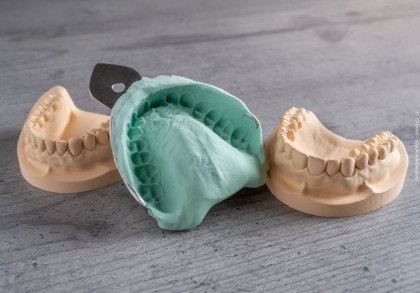 Auf dem Bild sind zwei Zahnmodelle und eine Zahnabdruckform zu sehen. Die Zahnmodelle sind cremefarben, während die Abdruckform aus mintgrünem Material besteht. Sie sind auf einer grauen, strukturierten Oberfläche platziert.