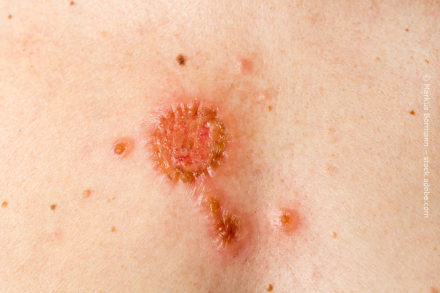 Nahaufnahme einer Hautpartie mit mehreren verdächtigen, erhabenen und geröteten Hautveränderungen. Die größte Läsion ist rund, geprägt und weist eine rötlich-braune Färbung auf, während die kleineren Läsionen verlaufen und ebenfalls erhaben sind.