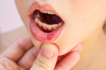 Nahaufnahme eines Mundes mit einem offenen Kinn und einem sichtbaren Geschwür auf der unteren Lippe. Eine Hand hält das Kinn leicht nach unten.