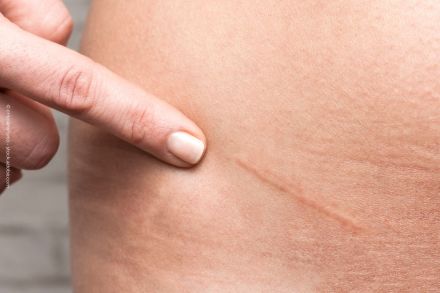 Nahaufnahme eines Fingers, der auf eine Narbe auf der Haut zeigt. Die Haut ist glatt und leicht gebräunt, und die Narbe ist gut sichtbar.