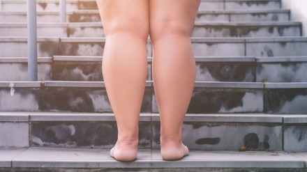 Rückansicht von Beinen einer Person mit Lipödem, die eine Treppe hinaufgeht, zeigt deutliche Schwellungen und ungleichmäßige Fettverteilung an den Waden.
