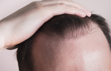 Haarverlust gibt es bei Männern und Frauen.