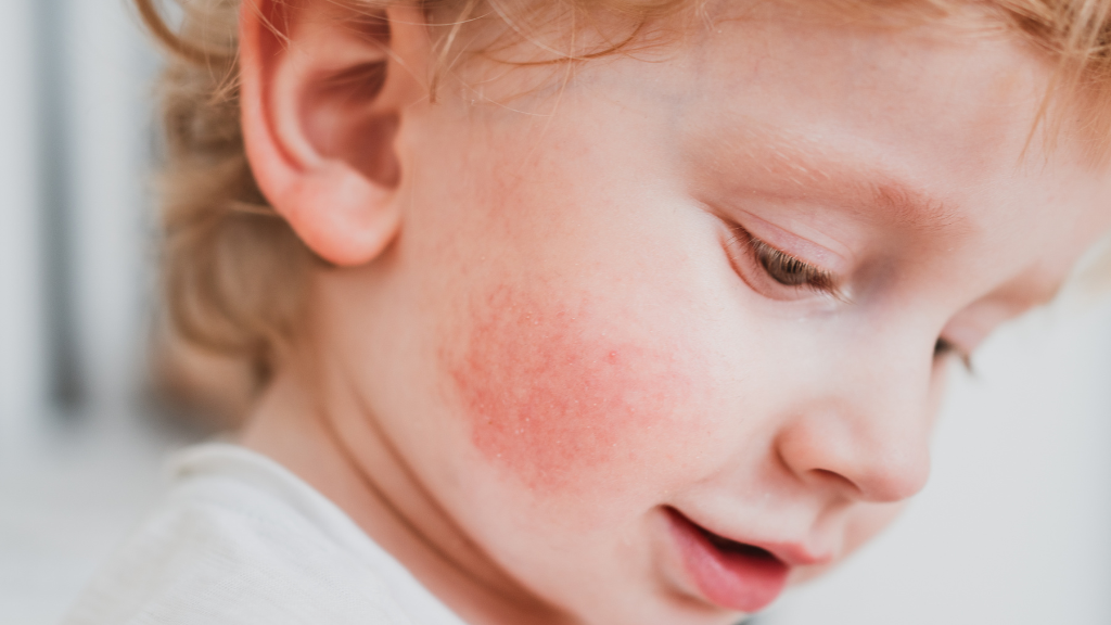 Ringelröteln Ab Wann Nicht Mehr Ansteckend Ringelröteln bei Kindern: Symptome, Ursachen und Behandlung