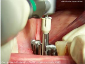 017 cas clinique dr eric castel guide positdental bpqyyr - Eugenol