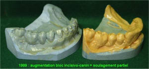 04 edentement unilateral lp2qzb - Eugenol
