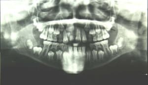 11 mtmfcx - Eugenol