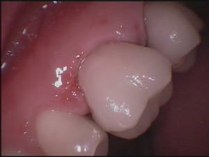 16 après scellement kz1vjw - Eugenol
