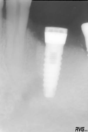 4 implant 28 9 07 iqohwd - Eugenol