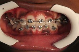 Bouche fermee rjseyc - Eugenol