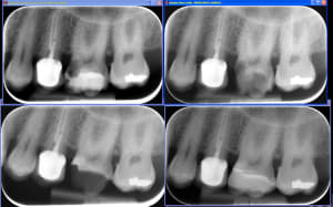 Biodentineremontedemargeonlay ltoomd - Eugenol