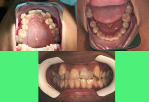Bouche 1 zehenf - Eugenol