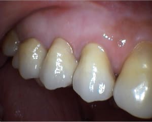 Bridge 14 16 drfsde - Eugenol