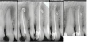 Claudette necrose granulome vsr03z - Eugenol