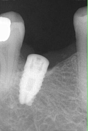 Capture implant yxprhv - Eugenol