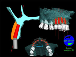 Comment simplifier et fiabiliser les greffes cas clinique dr pxav 2 xckumk - Eugenol