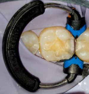 Composi tight 3d xr - Eugenol