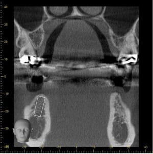 Coupe 4 implant 46 hjc8ip - Eugenol