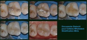 Dietschi uidhth - Eugenol