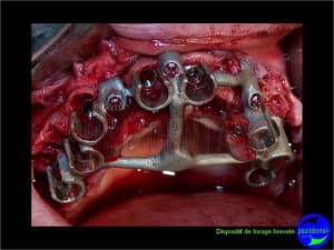 Eimci et canine incluse positdental 09 cii9k6 - Eugenol