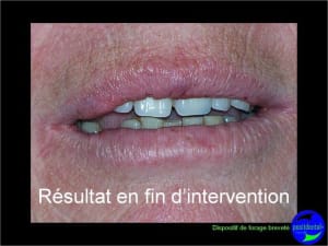 Eimci et canine incluse positdental 13 uk1q7j - Eugenol