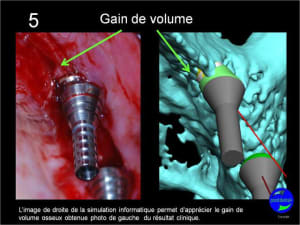 Expansion  condensation guid e  positdental 06 hluw2s - Eugenol