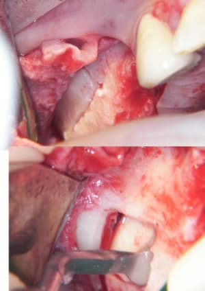Expansion osseuse et sinus lift 1 s2vt0l - Eugenol