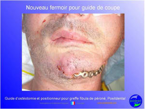Guide d ost otomie  positionneur fibula positdental001 sgakt2 - Eugenol