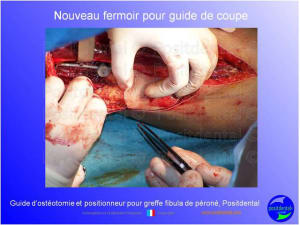 Guide d ost otomie  positionneur fibula positdental003 ranupp - Eugenol
