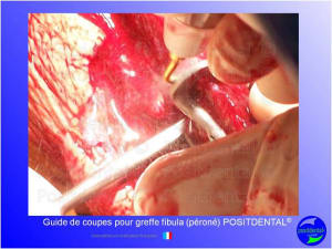 Guide de coupes pour greffe fibula  p ron   positdental 016 fl89sh - Eugenol