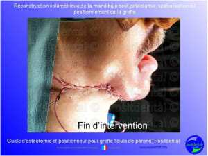 Guide de coupes pour greffe fibula  p ron    positdental 012 qzjure - Eugenol