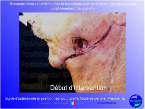 Guide de coupes pour greffe fibula  p ron    positdental 013 rrmzdd - Eugenol