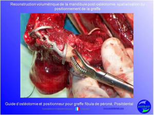 Guide de coupes pour greffe fibula  p ron    positdental 018 pbyf3a - Eugenol