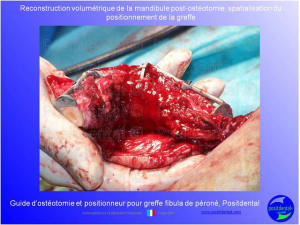 Guide de coupes pour greffe fibula  p ron    positdental 023 dnlcfp - Eugenol