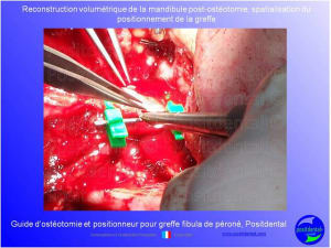 Guide de coupes pour greffe fibula  p ron    positdental 025 ikzhqr - Eugenol