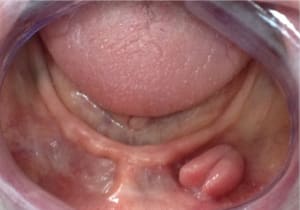Hypertrophie fn1cvt - Eugenol