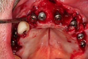 Img implants nekqvy - Eugenol