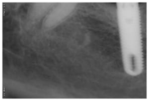 Implant46 1 ommfqt - Eugenol