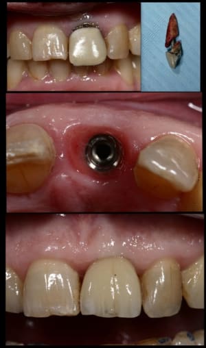 Implants2 mhbefu - Eugenol