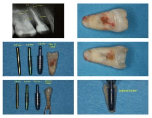 Implant 15 wxg4o7 - Eugenol