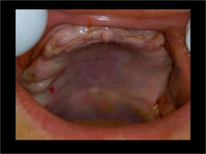 Implant astra et mci 002 luhhuw - Eugenol