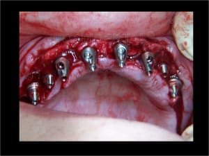 Implant astra et mci 004 twuu7p - Eugenol