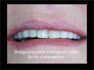 Implant astra et mci 005 frxkrl - Eugenol